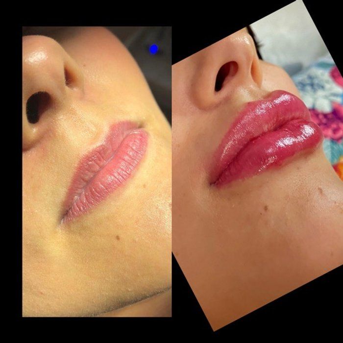 Dra Gabrielle Bieli - Harmonização Facial - preenchimento labial