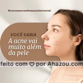 A acne vai muito além de espinhas. Ela pode afetar profundamente nossa autoestima e saúde mental.  As marcas na pele podem se transformar em cicatrizes emocionais.  É hora de falar sobre isso!  
#acne #saudemental #autoestima #beleza #ahazou #tendência 