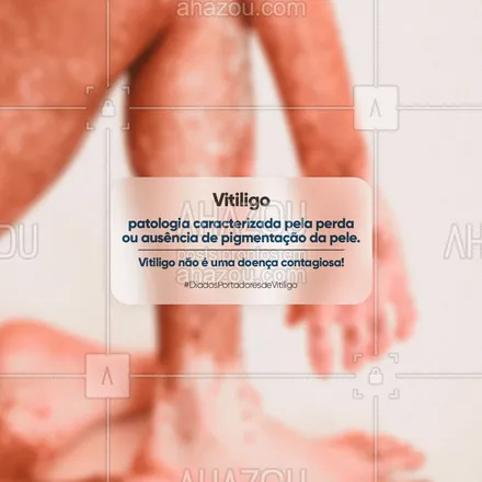 posts, legendas e frases de posts para todos para whatsapp, instagram e facebook: A informação quebra as barreiras do preconceito! Mantenha-se sempre informado! 01.08 - dia nacional dos portadores de vitiligo. ??
#ahazou #frasesmotivacionais #motivacionais #vitiligem #perfectskin #pele #skin #vitiligo #ahazou 