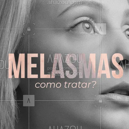 posts, legendas e frases de estética facial para whatsapp, instagram e facebook: O melasma é composto por manchas escuras na pele e para seu tratamento podem ser usados cremes clareadores, como a hidroquinona ou tretinoína, tratamentos estéticos, como laser, microagulhamento ou peeling químico, tudo orientado por um dermatologista.   #melasma #esteticafacial #ahazou #bandbeauty 