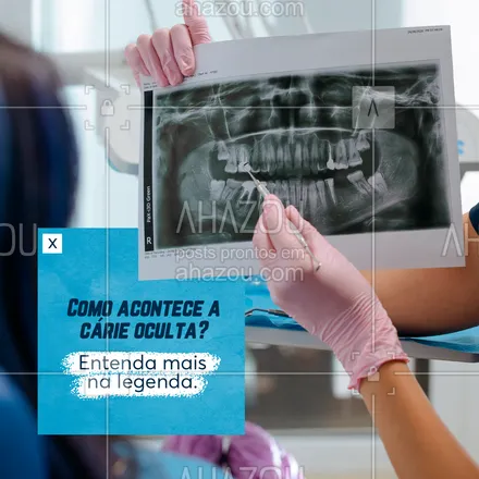 posts, legendas e frases de odontologia para whatsapp, instagram e facebook: Diferente da cárie comum, a cárie oculta é mais difícil de ser detectada e pode acontecer sem a necessidade de desgastar o dente e deixar aquele pontinho preto que conhecemos bem. No caso, as bactérias podem penetrar o dente por defeitos estruturais ou fissuras na parte superior, instalando-se no local e desenvolvendo a cárie. #AhazouSaude #bemestar  #odonto  #odontologia  #saude 